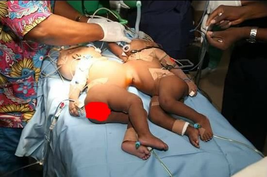 Again, Nigerian doctors separate conjoined twins