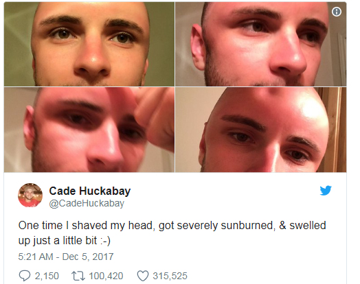 This man's sunburn was so severe it caused a dent in his head
