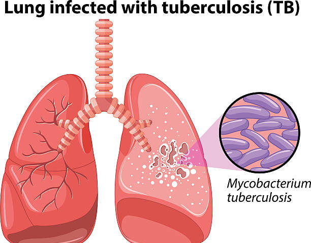 Tuberculosis: NGO Trains 60 Health Workers in Benue