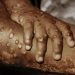 Alt="Rivers Govt. Confirms 2 Cases Of Monkeypox"