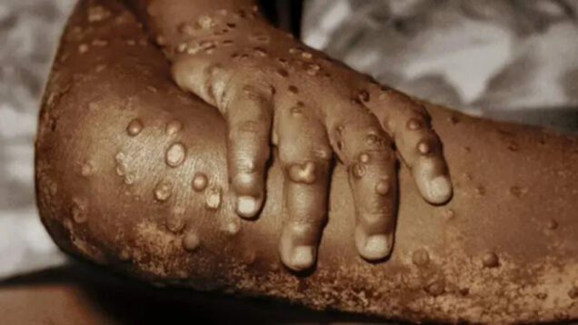 Alt="Rivers Govt. Confirms 2 Cases Of Monkeypox"