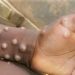 A’Ibom Records 5 Cases Of Mpox- Official